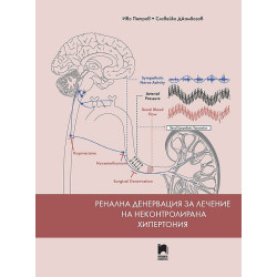 Ренална денервация за лечение на неконтролирана хипертония
